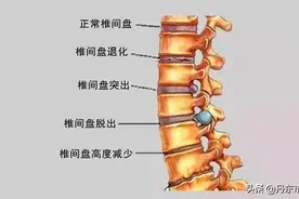 健康·科普 | 腰椎间盘突出症图片