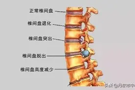 健康·科普 | 腰椎间盘突出症图片