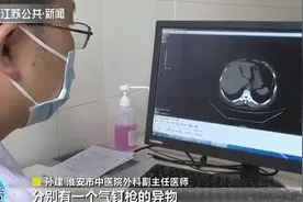 气钉枪突然“走火”两颗钉子射入男子体内图片