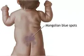 为什么很多刚出生的婴儿，屁股上有一片“淤青”？终于知道答案了图片