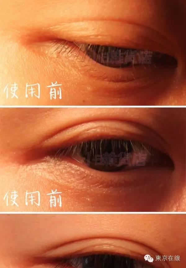 「优质港货」日本蛇毒眼膜真的那么厉害？