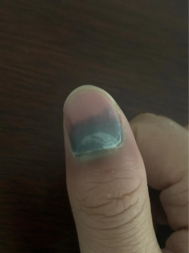 指甲盖被砸了有瘀血怎么办
