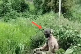 嘉兴男子钓鱼触碰高压电，衣服和头发都烧没了，脸变漆黑图片