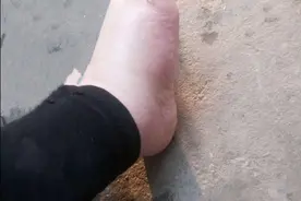为什么一到夏季腿和脚就容易肿胀？图片