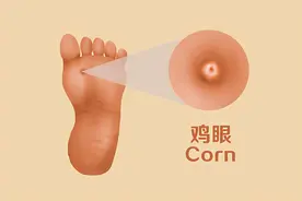 脚上长了鸡眼，有什么好方法能去除？鸡眼的原因有哪些？图片