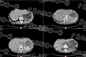 食管癌如何治疗/广东肿瘤医院图片