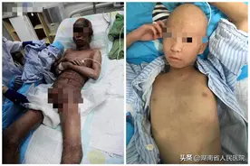 罕见，湖南一少年全身痂皮似“盔甲”，“卸甲”迎新生图片