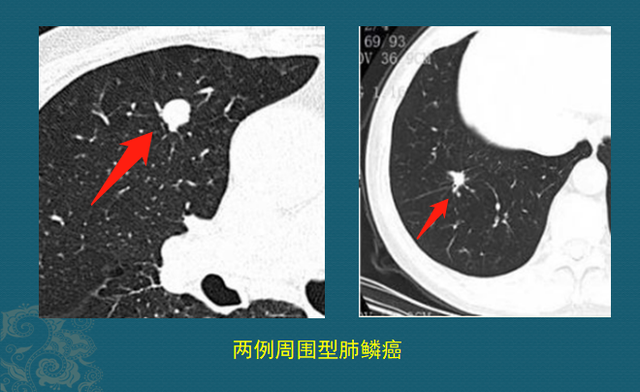 肺癌病理非角化型鳞癌