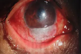 【爱眼护眼77】眼睛里进了异物怎么办图片