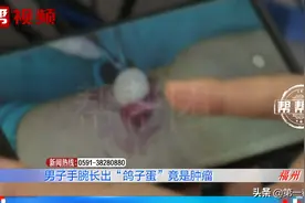 手腕鼓包，一碰就发麻，医生竟从中取出酷似“鸽子蛋”的肿物图片