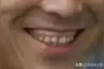 “颜值杀手露龈笑”的3种改善方式，治标治本的都有......图片