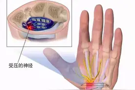 常手麻、手痛，究竟是哪里的问题？不出意外，这5种可能性最大图片