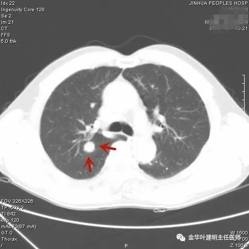 叶建明谈结节：检查发现肺实性结节怎么办？个人版实用指南