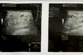 乳腺彩超报告，没有这几点就不必过于忧心图片