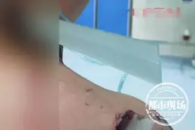 上厕所玩手机太久，20岁小伙起身时晕倒，2块玻璃刺入体内10厘米图片