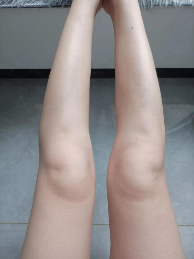 维A酸乳膏去鸡皮肤有用吗