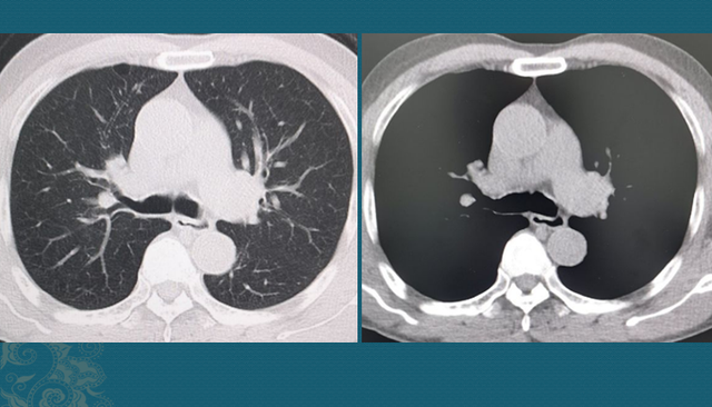 非角化鳞癌原位红肿痒是复发了吗