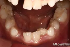 老人常说：矫正须等12岁后换完牙做！你认为这样的说法对吗？图片