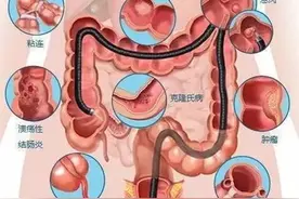 小肠肿瘤与结肠癌有哪些症状？需要做哪些检查才能确诊？图片