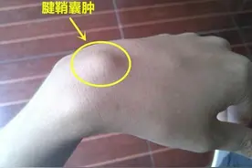 骨科常见疾病科普——腱鞘囊肿图片