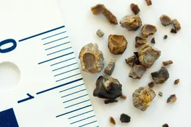 胆囊切除对身体有何影响？这2种后遗症的确存在，短时间内不好受图片