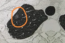 同样是肺结节，原位癌、微浸润癌、浸润癌有何区别？看完涨知识了图片