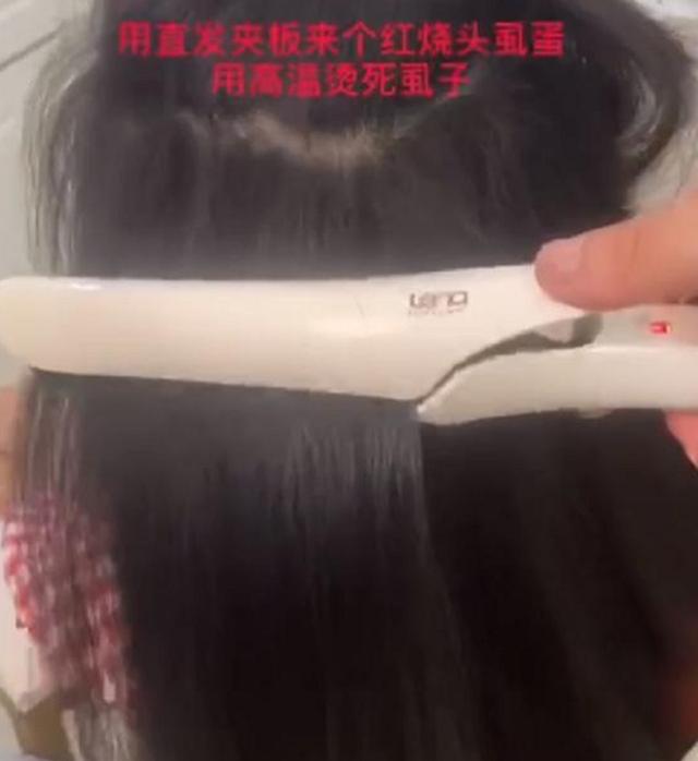 女儿头上长了许多虱子，宝妈用热夹板把头发烫了烫，结果很舒适