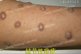 恼人的结节性痒疹图片