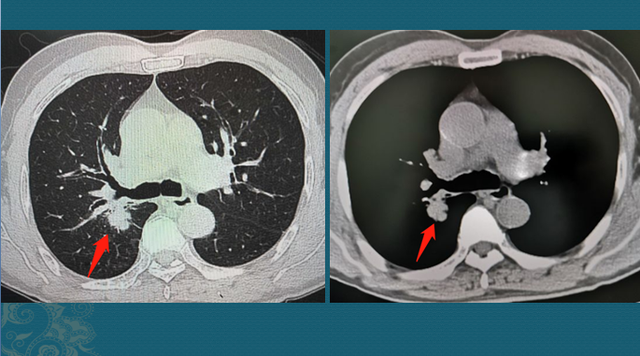 非角化鳞癌原位红肿痒是复发了吗