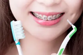 娃娃几岁才能箍牙？箍牙能瘦脸吗？华西口腔专家：6个箍牙提醒图片