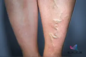 青筋凸起，表示血管毒素淤积？这4个部位凸起，别不当回事…图片