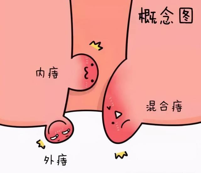 疮的种类有哪些种类（科普丨痔疮种类及到底如何治疗）