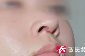 “鼻子像匹诺曹，凸出来了”！女子哭诉鼻整形后红肿发炎，卫健部门已立案调查图片