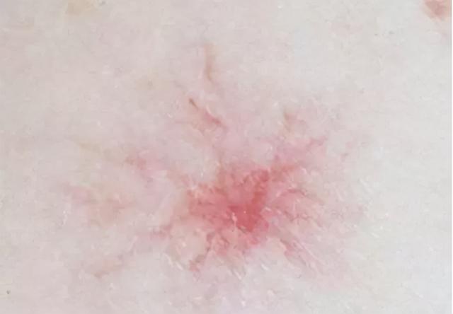 满身都是小红点