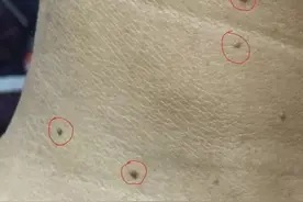 犹如老年斑的扁平疣，严重影响美观，该如何处理？图片