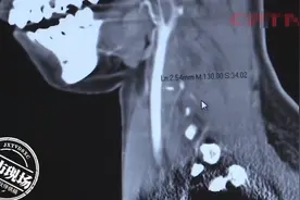 女子一转头就痛，1根3厘米鱼刺深藏颈部，喉镜很难发现图片