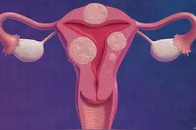 女性如何预防子宫肌瘤？不是不喝豆浆，而是远离3种常见美食图片