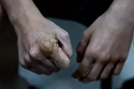 脑瘫儿把父亲当人肉沙包练拳，后来他成拳王，父亲却被打失明肾衰图片