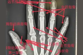学习《X线读片指南》骨、关节系统——手图片