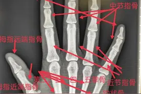 学习《X线读片指南》骨、关节系统——手图片