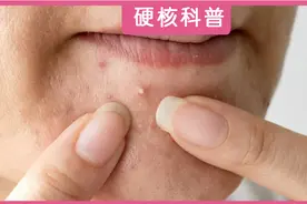 全身感染生命垂危，只因挤了一颗痘痘！医生提醒：这些痘痘不能动图片