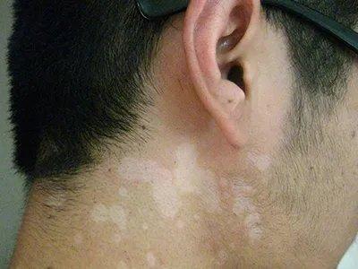 千万别看错!不是所有的白斑都是白癜风