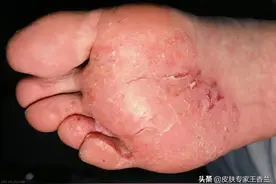 脚癣反复发作？可能是你用错了方法图片