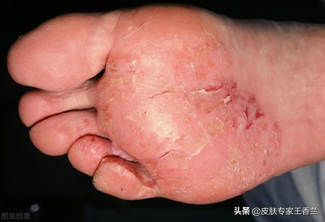 脚底表皮角化过度