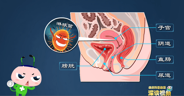 全球每年约20万妇女得淋病？淋病知识解读