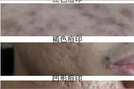 深浅不一、坑坑洼洼的痘印，严重影响颜值，怎么预防和处理图片