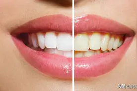 为什么天天刷牙牙齿还是又臭又黄？专家：不注意这几点，就白刷了图片