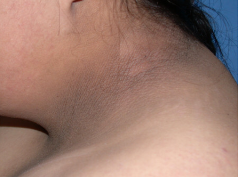 角化过度角化不全炎症