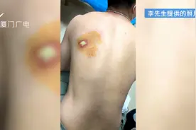 男子用红豆袋理疗热敷，却被烫出永久性伤疤！理疗店负责人：出于情分愿赔一万，但这个伤口我们不能理解图片