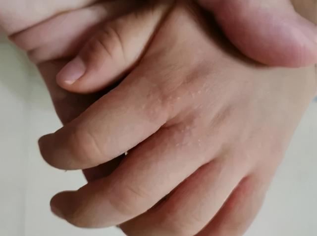 宝宝手上长湿疹痒怎么办